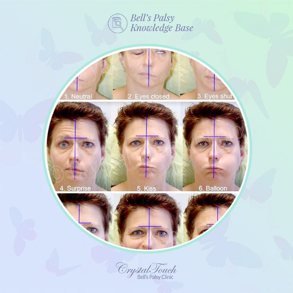 Measuring your recovery progress after Bell's palsy