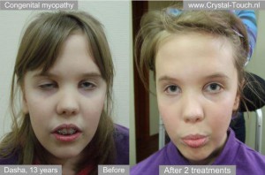 Dasha before and after Bell's palsy treatment
