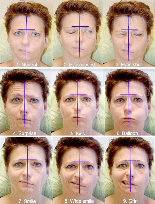 Неврологические пробы после неврита лицевого нерва и синкинезий
