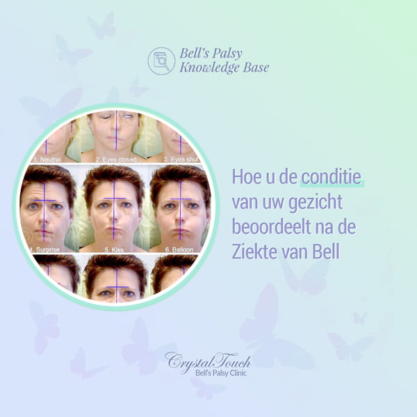 Hoe u de conditie van uw gezicht beoordeelt na de Ziekte van Bell