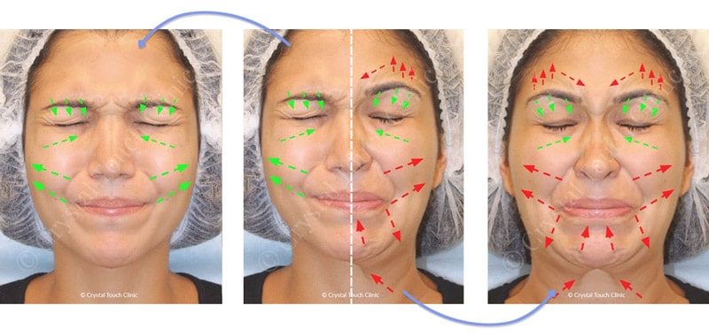 Синкинезия лица - оригинал (центр), зеркальные здоровая сторона (слева) и пораженная сторона (справа)