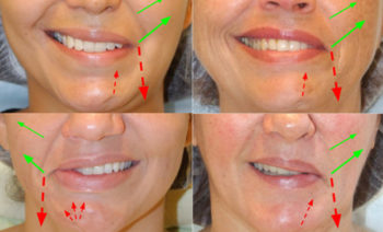 Bell's palsy - synkinetic smile