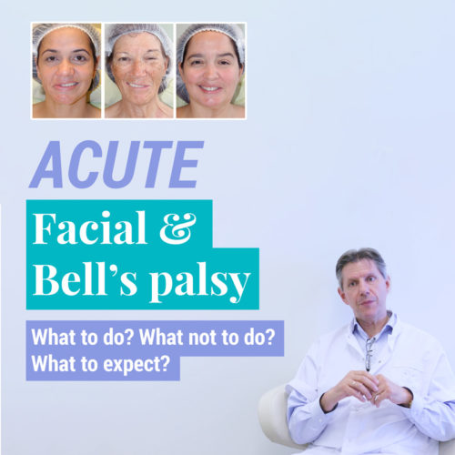 Acute facial and bell's palsy