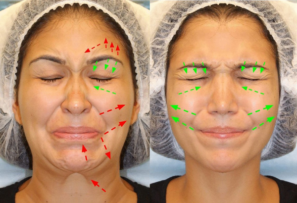 Направление сокращений лицевых мышц при зажмуривании глаз