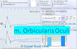 nerve conduction Orbicularis Oculi