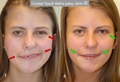 Aline - congenital facial palsy - before and after - big smile