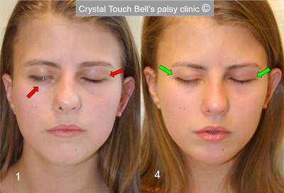 Алина - врожденная невропатия лицевого нерва - до и после - закрытые глаза