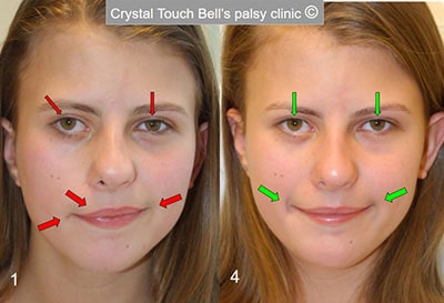 Алина - врожденная невропатия лицевого нерва - до и после - маленькая улыбка