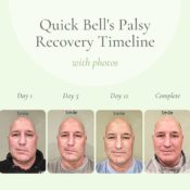 Quick Bell's Palsy recovery timeline (with photos)