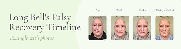 Long Bell's Palsy recovery timeline (with photos)