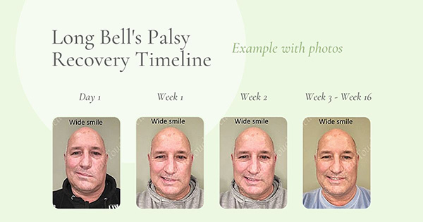 Long Bells Palsy Recovery Timeline