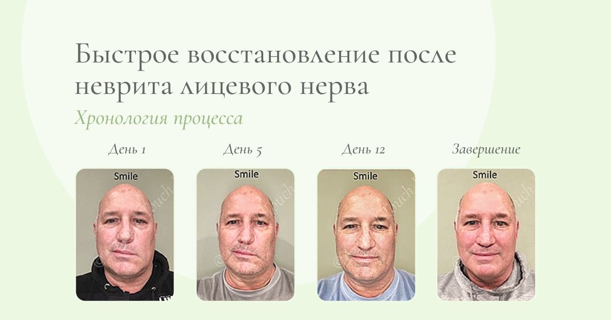Неврит зрительного нерва мкб. Неврит зрительного нерва мкб